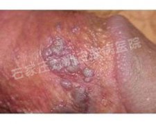 尖锐湿疣的发病机制都是怎样的?