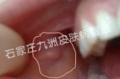 尖锐湿疣治疗消除疣体后要如何预防复发?