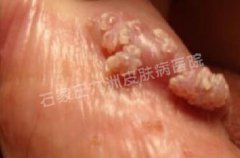 尖锐湿疣传统治疗能不能消除病毒呢?