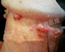 尖锐湿疣哪些病毒类型更易导致癌变呢?