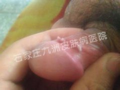 尖锐湿疣患者如何选择药物去治愈呢?