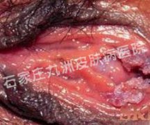 阴道口湿疣都是什么样的症状体现?
