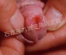 尖锐湿疣什么方法治疗才能完全治愈不复发?