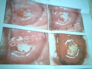  ʪഫͳܲhpv?