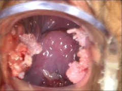 ʪ󻹻hpv?