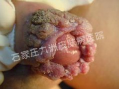 ʪ໼ѪҺлhpv?