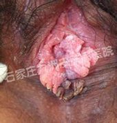 ʪʲôҩhpv?