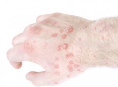 湿疹患者治疗上如何选择药物能更好的缓解皮肤损害?