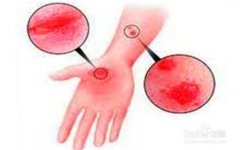 手部湿疹应当怎样做好生活辅助能减少伤害?