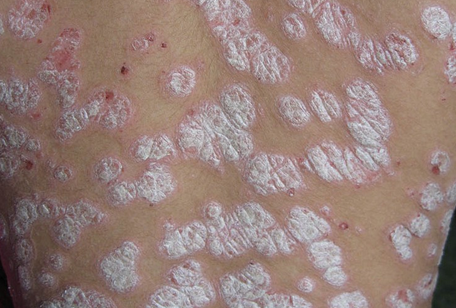 牛皮癣需要如何检查和确诊具体病情?