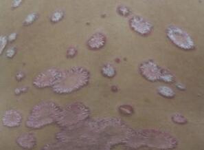 牛皮癣饮食上需要特别注意忌口吗?