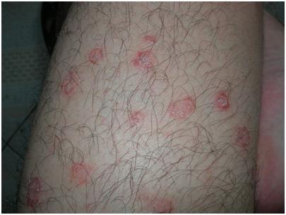 牛皮癣中医中药治疗怎么样呢?