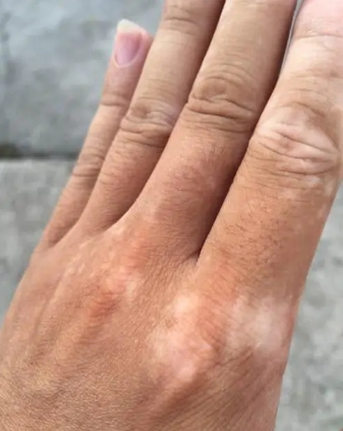 白癜风要和哪些常见皮肤病鉴别?