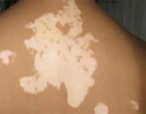 白癜风临床上都有哪些类型和特征?