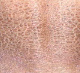 鱼鳞病会有哪些症状和类型表现?