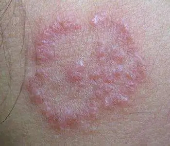 过敏性皮炎都有哪些症状和表现呢?