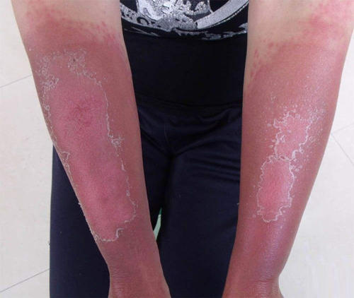 过敏性皮炎不治疗会自己好吗?