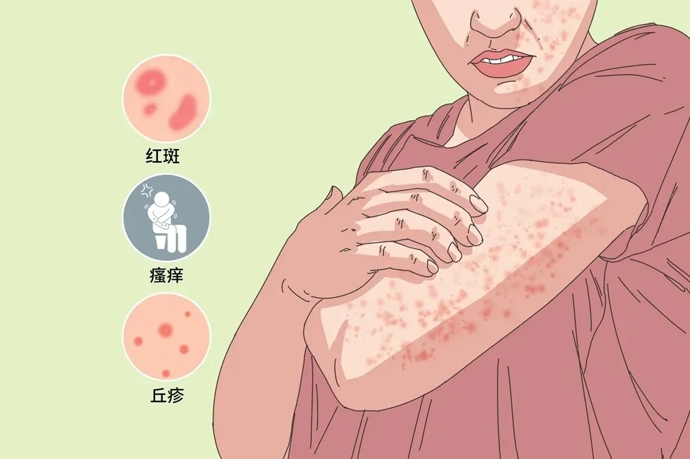 皮肤过敏期间可以吃牛羊肉吗怎样护理好呢?