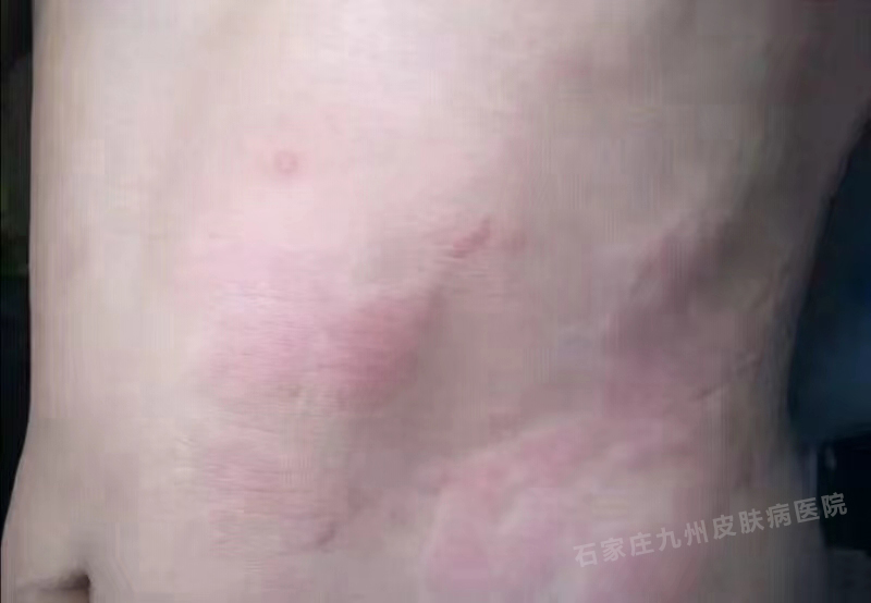 荨麻疹是不是会瘙痒为什么呢?