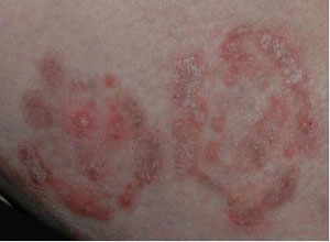 体癣是不是真菌感染引起的疾病?