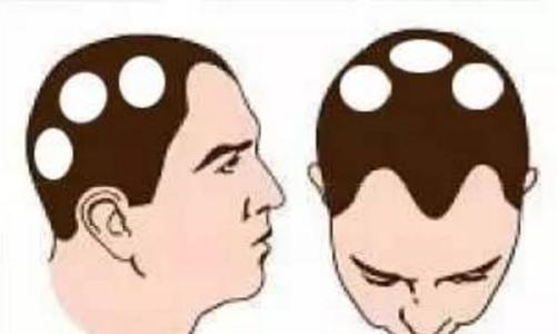 斑秃就是单纯的掉头发吗?