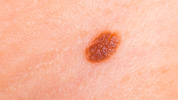 生活中胎记的类型表现都有哪些呢?