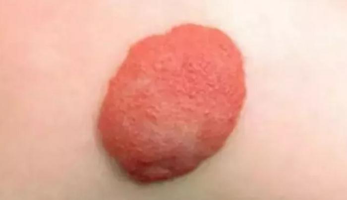 胎记究竟需不需要特别治疗呢?