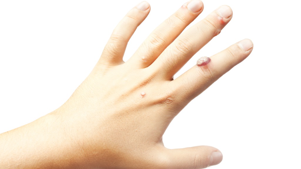 引起寻常疣的原因都有哪些呢?