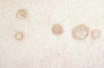 寻常疣是什么样子的有什么特征呢?