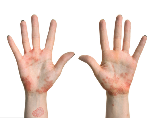 手癣是细菌感染引起的吗?