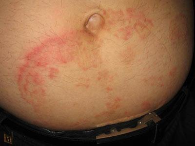 体癣会引起皮肤出现发红现象吗?