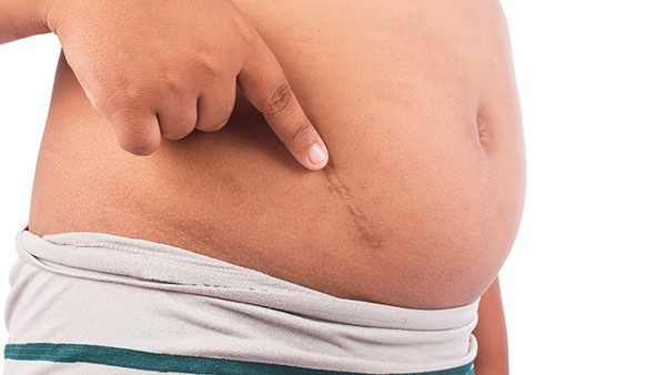 疤痕患者治疗后要如何做好护理呢?