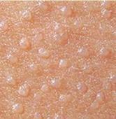 寻常疣日常生活要注意哪些事项呢?