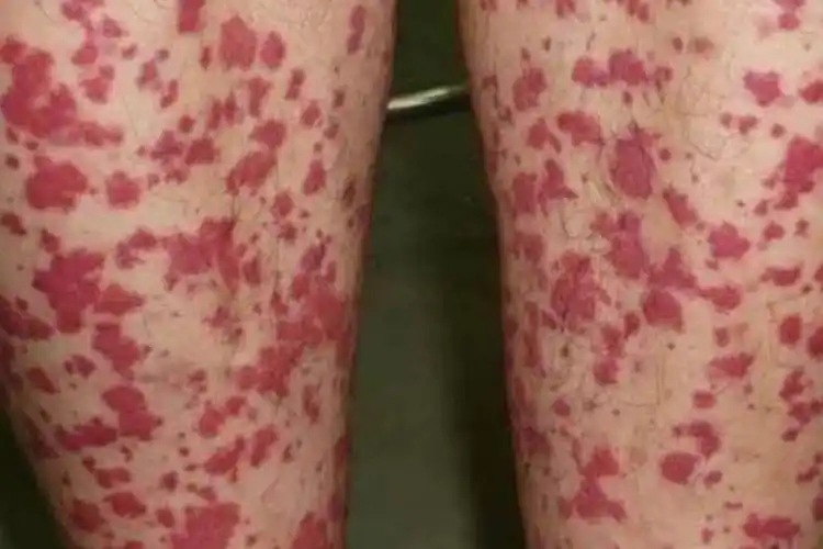 过敏性紫癜都有哪些症状和损害呢?