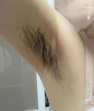 脱腋毛时需要注意什么事项呢?