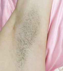 腋毛脱除后还会再长吗?
