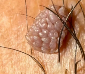 湿疣治疗后为什么会反复复发呢?