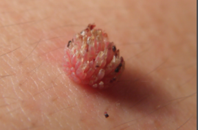 湿疣患者生活需要注意哪些事项呢?