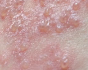 生殖疱疹会有潜伏期吗?