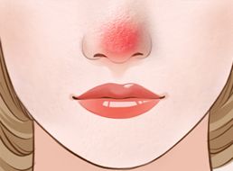 酒糟鼻的出现和喝酒有关系吗?