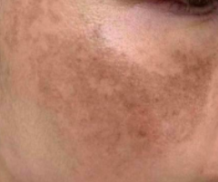 黄褐斑应当注意哪些事项比较好?