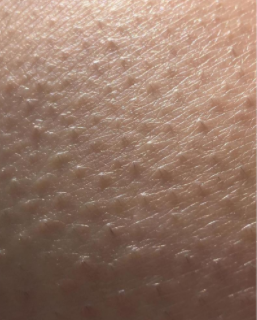 毛周角化症和毛囊炎有什么区别?