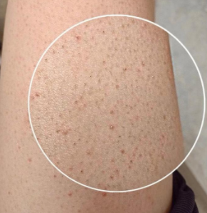 毛周角化症要注意哪些事项如何护理呢?