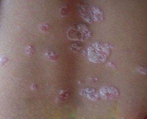 银屑病是不是真菌感染引起的，有什么区别?