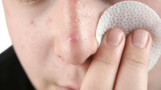 青春痘除了粉刺外还有哪些症状损害?