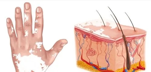 白癜风病程发展都有哪些阶段?