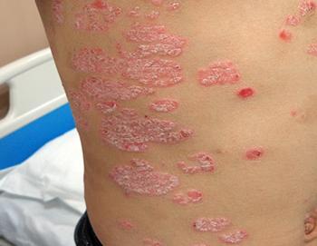 银屑病发病都有哪几个时期呢?