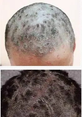 脂溢性皮炎会有灼烧感吗?