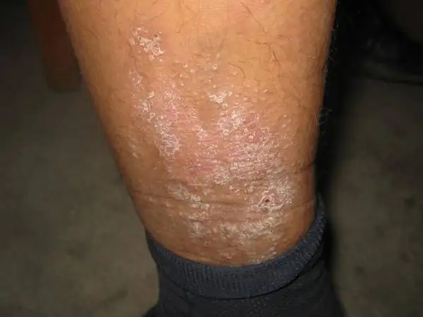 神经性皮炎一般好发于什么部位上?