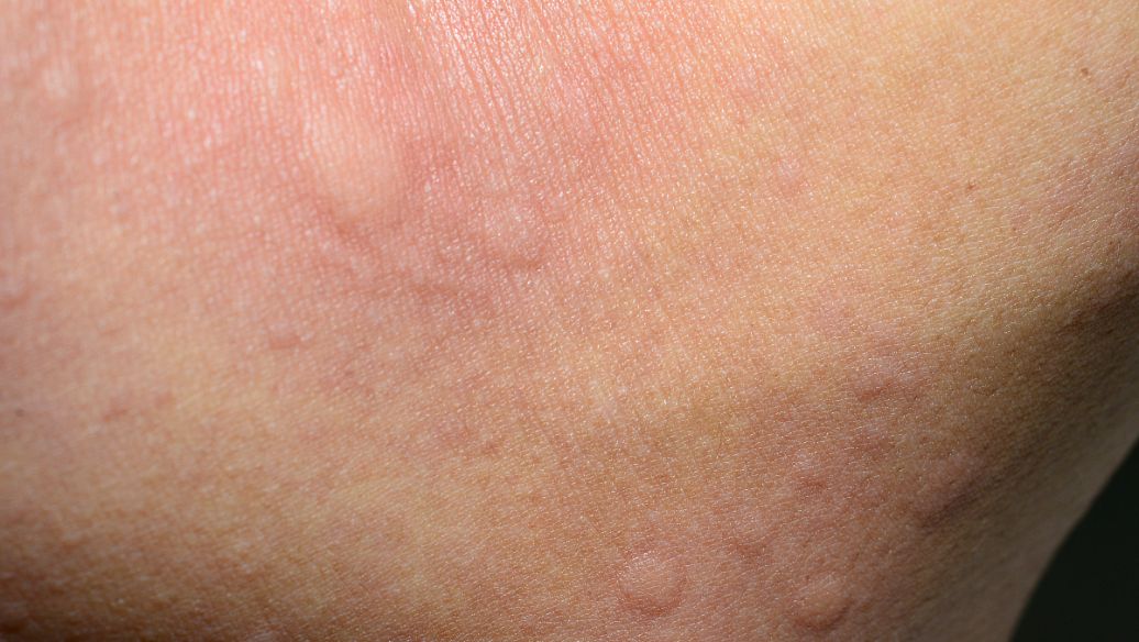 寻常疣治疗去除后还会再复发吗?